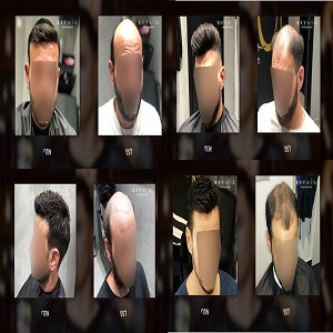 יחידות שיער לגברים –הבחירה הכי מתאימה לך